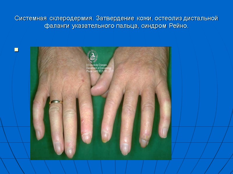 Системная склеродермия. Затвердение кожи, остеолиз дистальной фаланги указательного пальца, синдром Рейно.